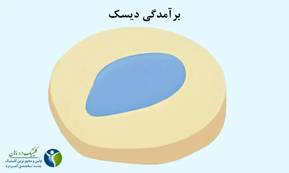 برآمدگی دیسک