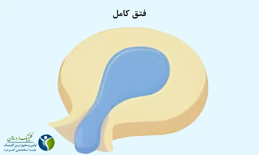 فتق کامل