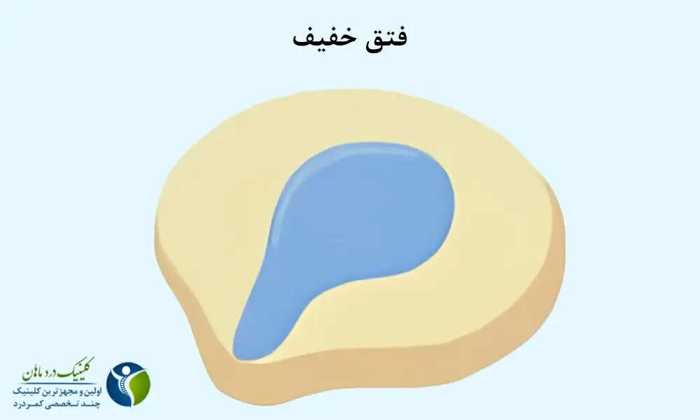 فتق خفیف