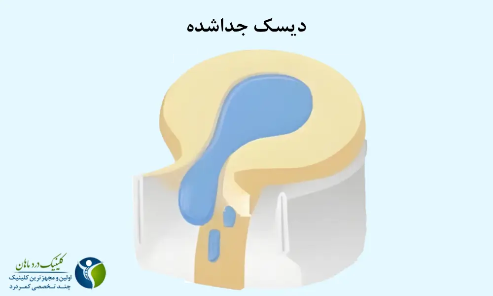 دیسک جداشده