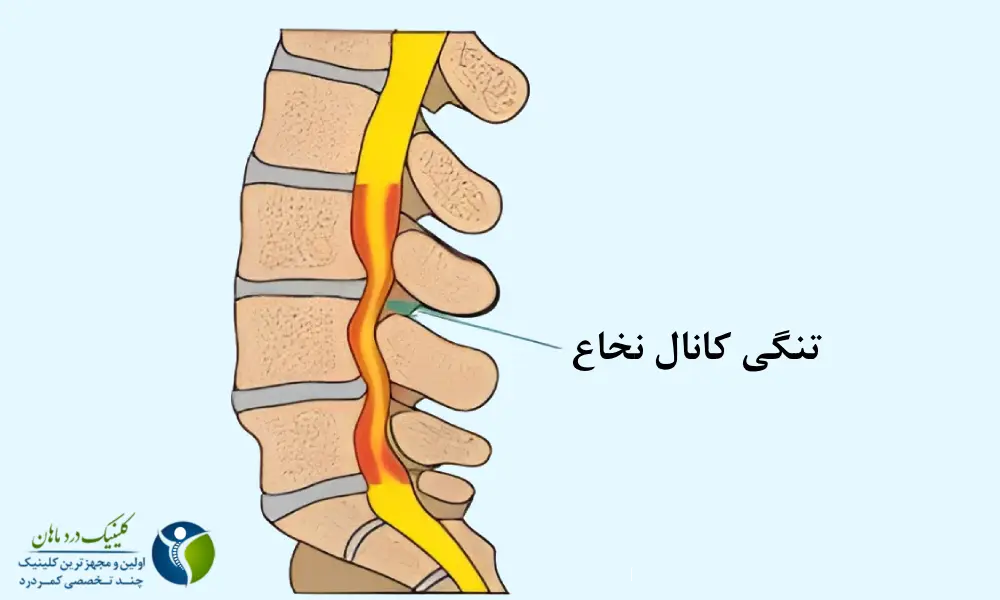 تنگی کانال نخاع